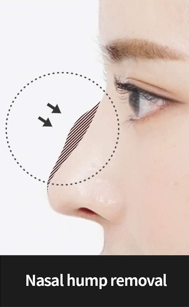 best rhinoplasty surgeons